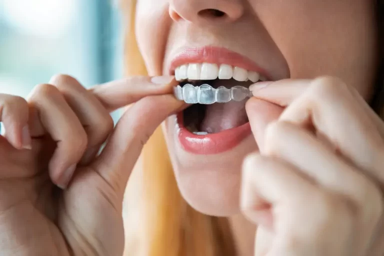 How Often Should I Visit The Dentist During Invisalign Treatment?