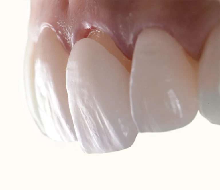 5 Types Of Veneers – Which One Is Right For You?